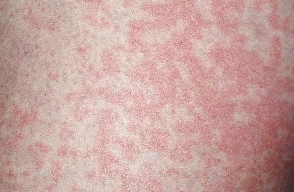 男子把袜子衣服同洗致感染 医生提醒：三件事要特别注意